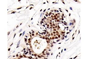 Immunohistochemistry analysis of paraffin-embedded human breast cancer using HDAC1 Polyclonal Antibody at dilution of 1:300. (HDAC1 antibody)