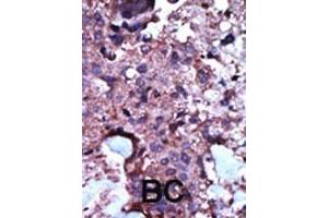 Formalin-fixed and paraffin-embedded human cancer tissue reacted with the primary antibody, which was peroxidase-conjugated to the secondary antibody, followed by AEC staining. (PKLR antibody  (N-Term))