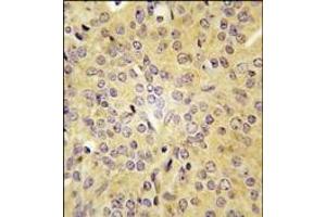 Formalin-fixed and paraffin-embedded human prostata carcinoma tissue reacted with LARS antibody (C-term), which was peroxidase-conjugated to the secondary antibody, followed by DAB staining. (LARS antibody  (C-Term))