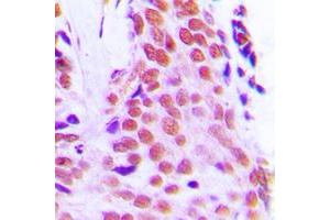 Immunohistochemical analysis of RPL28 staining in human breast cancer formalin fixed paraffin embedded tissue section. (RPL28 antibody  (Center))