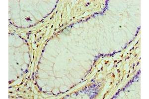 Immunohistochemistry of paraffin-embedded human colon cancer using ABIN7153892 at dilution of 1:100 (GCKR antibody  (AA 1-625))