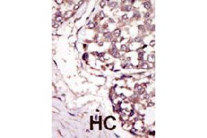 Formalin-fixed and paraffin-embedded human hepatocellular carcinoma tissue reacted with RYK polyclonal antibody  , which was peroxidase-conjugated to the secondary antibody, followed by DAB staining. (RYK antibody  (C-Term))