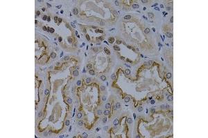 Immunohistochemistry of paraffin-embedded human kidney cancer using TNFRSF6B antibody (ABIN5970241) at dilution of 1/200 (40x lens). (TNFRSF6B antibody)
