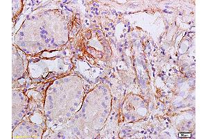 Formalin-fixed and paraffin embedded human esophageal carcinoma labeled Anti-Collagen II Polyclonal Antibody, Unconjugated (ABIN672171) at 1:200, followed by conjugation to the secondary antibody and DAB staining (COL2 antibody  (AA 1201-1300))