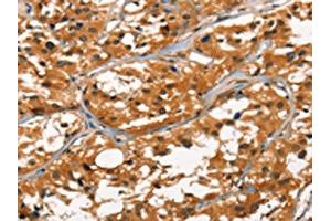 The image on the left is immunohistochemistry of paraffin-embedded Human thyroid cancer tissue using ABIN7190457(DEFA1/3 Antibody) at dilution 1/30, on the right is treated with synthetic peptide. (DEFA1/DEFA3 antibody)