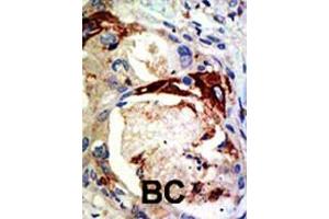 Formalin-fixed and paraffin-embedded human cancer tissue reacted with the primary antibody, which was peroxidase-conjugated to the secondary antibody, followed by DAB staining. (MYB antibody  (Sumoylation Site))