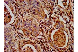 IHC image of ABIN7160835 diluted at 1:300 and staining in paraffin-embedded human cervical cancer performed on a Leica BondTM system. (NLRP7 antibody  (AA 89-187))