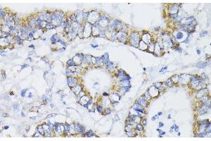 Immunohistochemistry of paraffin-embedded Human colon carcinoma using PDHA1 Polyclonal Antibody at dilution of 1:200 (40x lens). (PDHA1 antibody)