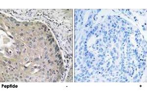 Immunohistochemistry analysis of paraffin-embedded human lung carcinoma tissue, using AOX1 polyclonal antibody . (AOX1 antibody)