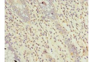 Immunohistochemistry of paraffin-embedded human colon cancer using ABIN7167492 at dilution of 1:100 (RTP4 antibody  (AA 1-224))