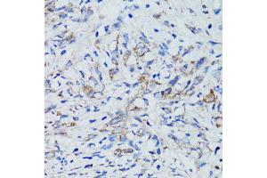 Immunohistochemistry of paraffin-embedded human uterine cancer using USO1 antibody (ABIN1875291) at dilution of 1:100 (40x lens). (USO1 antibody)