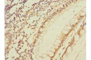 Immunohistochemistry of paraffin-embedded human colon cancer using ABIN7160425 at dilution of 1:100 (MPZL2 antibody  (AA 30-140))
