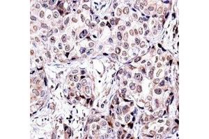SIRT6 antibody immunohistochemistry analysis in formalin fixed and paraffin embedded human breast carcinoma. (SIRT6 antibody  (AA 276-305))