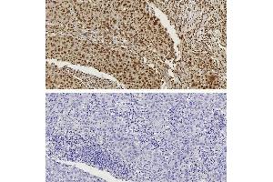 CTCF antibody (pAb) tested by Immunohistochemistry Nuclear staining pattern is detected in Formalin-fixed, paraffin-embedded tissue sections from human breast carcinoma. (CTCF antibody  (N-Term))