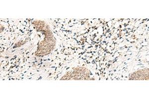 Immunohistochemistry of paraffin-embedded Human esophagus cancer tissue using SNRPG Polyclonal Antibody at dilution of 1:40(x200) (SNRPG antibody)