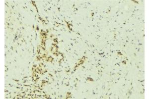 ABIN6277007 at 1/100 staining Human breast cancer tissue by IHC-P.