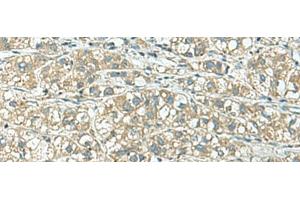 Immunohistochemistry of paraffin-embedded Human liver cancer tissue using KCNJ2 Polyclonal Antibody at dilution of 1:25(x200) (KCNJ2 antibody)