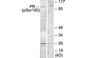 Immunohistochemistry analysis of paraffin-embedded human breast carcinoma, using Progesterone Receptor (Phospho-Ser190) Antibody.