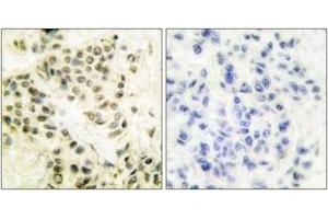 Immunohistochemistry analysis of paraffin-embedded human breast carcinoma tissue, using DNA-PK Antibody.