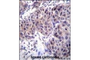 DVL3 Antibody (C-term) (ABIN655969 and ABIN2845354) immunohistochemistry analysis in formalin fixed and paraffin embedded human breast carcinoma followed by peroxidase conjugation of the secondary antibody and DAB staining. (DVL3 antibody  (C-Term))