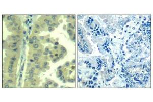 Immunohistochemical analysis of paraffin-embedded human lung carcinoma tissue using eIF4G(Ab-1232) Antibody(left) or the same antibody preincubated with blocking peptide(right). (EIF4G1 antibody)