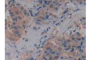IHC-P analysis of Human Breast cancer Tissue, with DAB staining. (SLC9A3R2 antibody  (AA 56-337))