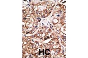 Formalin-fixed and paraffin-embedded human cancer tissue reacted with the primary antibody, which was peroxidase-conjugated to the secondary antibody, followed by DAB staining. (NEUROD1 antibody  (N-Term))