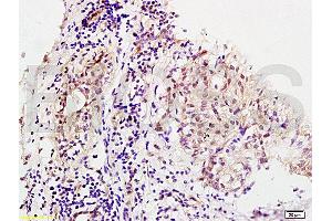 Formalin-fixed and human breast carcinoma tissue labeled with Anti-MMS19 Polyclonal Antibody, Unconjugated (ABIN1387802) at 1:200 followed by conjugation to the secondary antibody and DAB staining (MMS19 antibody  (AA 851-950))