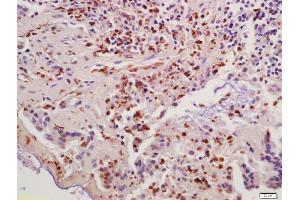 Formalin-fixed and paraffin embedded human colon carcinoma labeled with Anti-Cyclin B1 Polyclonal Antibody, Unconjugated (ABIN670296) at 1:200 followed by conjugation to the secondary antibody and DAB staining (Cyclin B1 antibody  (AA 271-433))
