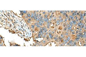 Immunohistochemistry of paraffin-embedded Human colorectal cancer tissue using CEACAM8 Polyclonal Antibody at dilution of 1:30(x200) (CEACAM8 antibody)