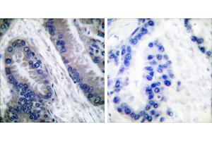 Cl-peptide - +Immunohistochemical analysis of paraffin-embedded human lung carcinoma tissue, using Caspase 1 (Cleaved-Asp210) antibody. (Caspase 1 antibody  (Cleaved-Asp210))
