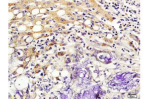 Formalin-fixed and paraffin embedded human colon cancer labeled with Rabbit Anti-Kiss 1/Kisspeptin Polyclonal Antibody (ABIN672726), Unconjugated 1:200 followed by conjugation to the secondary antibody and DAB staining. (KISS1 antibody  (AA 81-145))