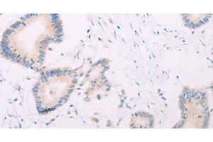 Immunohistochemistry of paraffin-embedded Human colon cancer tissue using MAP3K12 Polyclonal Antibody at dilution 1:30 (MAP3K12 antibody)