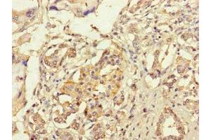 Immunohistochemistry of paraffin-embedded human pancreatic cancer using ABIN7167005 at dilution of 1:100 (KIAA1432 (KIAA1432) (AA 951-1233) antibody)