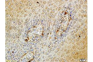 Formalin-fixed and paraffin embedded human endometrium carcinoma labeled with Rabbit Anti-Matriptase Polyclonal Antibody (ABIN669726), Unconjugated at 1:100 followed by conjugation to the secondary antibody and DAB staining. (ST14 antibody  (AA 11-100))