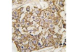 IHC analysis of FFPE human breast carcinoma tissue stained with ErbB2 antibody (ErbB2/Her2 antibody  (AA 21-52))