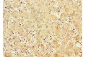 Immunohistochemistry of paraffin-embedded human liver cancer using ABIN7152685 at dilution of 1:100 (FRMD6 antibody  (AA 413-622))