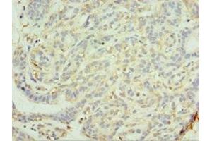 Immunohistochemistry of paraffin-embedded human breast cancer using ABIN7159289 at dilution of 1:100 (MAGEC2 antibody  (AA 1-150))
