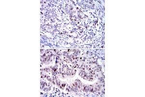 Immunohistochemical analysis of paraffin-embedded human cervical cancer (upper) and human rectum cancer (bottom) tissues using KIF22 monoclonal antibody, clone 5F3  with DAB staining.