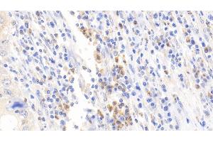 Detection of DPP3 in Human Lymphoma Tissue using Polyclonal Antibody to Dipeptidyl Peptidase 3 (DPP3) (DPP3 antibody  (AA 2-261))