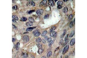 Immunohistochemistry of paraffin-embedded human breast carcinoma using Phospho-SRC-Y529 antibody (ABIN5969948).