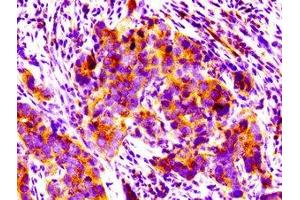 IHC image of ABIN7165944 diluted at 1:100 and staining in paraffin-embedded human pancreatic cancer performed on a Leica BondTM system. (PPM1F antibody  (AA 1-76))