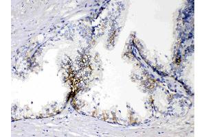 EPCAM was detected in paraffin-embedded sections of human prostatic cancer tissues using rabbit anti- EPCAM Antigen Affinity purified polyclonal antibody (Catalog # ) at 1 µg/mL. (EpCAM antibody  (Middle Region))