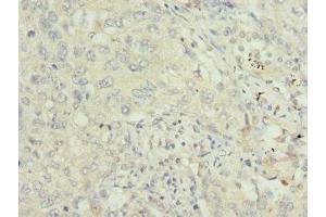 Immunohistochemistry of paraffin-embedded human lung cancer using ABIN7172240 at dilution of 1:100 (TRAF4 antibody  (AA 251-470))