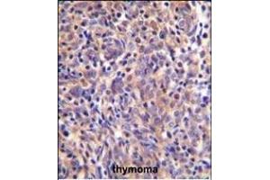 THEMIS Antibody (C-term) (ABIN655135 and ABIN2844761) immunohistochemistry analysis in formalin fixed and paraffin embedded human thymoma followed by peroxidase conjugation of the secondary antibody and DAB staining. (THEMIS antibody  (C-Term))