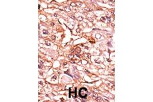 Formalin-fixed and paraffin-embedded human cancer tissue reacted with the primary antibody, which was peroxidase-conjugated to the secondary antibody, followed by AEC staining. (CDC25B antibody  (pSer353))