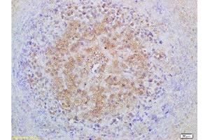 Formalin-fixed and paraffin embedded mouse lymphoma labeled with Anti-Smad3 Polyclonal Antibody, Unconjugated  at 1:200 followed by conjugation to the secondary antibody and DAB staining (Smad2/3 antibody  (AA 30-80))