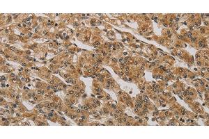 Immunohistochemistry of paraffin-embedded Human prostate cancer using BRAF Polyclonal Antibody at dilution of 1:30 (BRAF antibody)