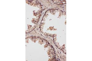 Anti-LCN1 antibody,IHC(P) IHC(P): Human Prostatic Cancer Tissue (Lipocalin 1 antibody  (Middle Region))