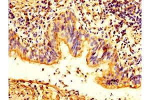 IHC image of ABIN7163503 diluted at 1:200 and staining in paraffin-embedded human lung cancer performed on a Leica BondTM system.